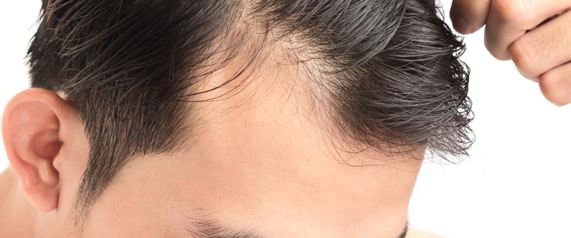 Understanding the Effects of DHT Levels on Hair Growth