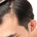 Understanding the Effects of DHT Levels on Hair Growth