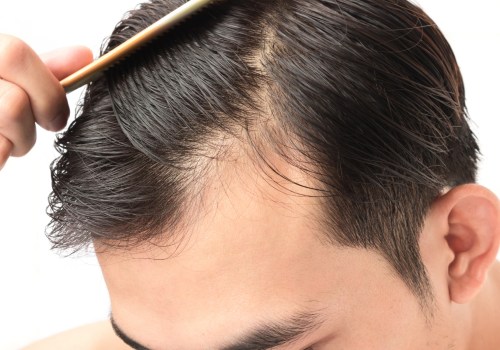 Understanding the Effects of DHT Levels on Hair Growth