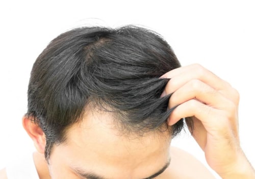 The Key Ingredients of f5x that Strengthen Hair Follicles